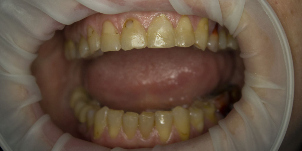  Восстановление двух зубов цельнокерамическими коронками Е-мах