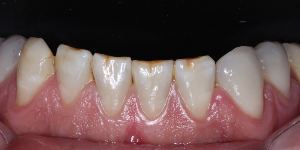 Трещины эмали гипоплазия Установка виниров на нижние передние зубы