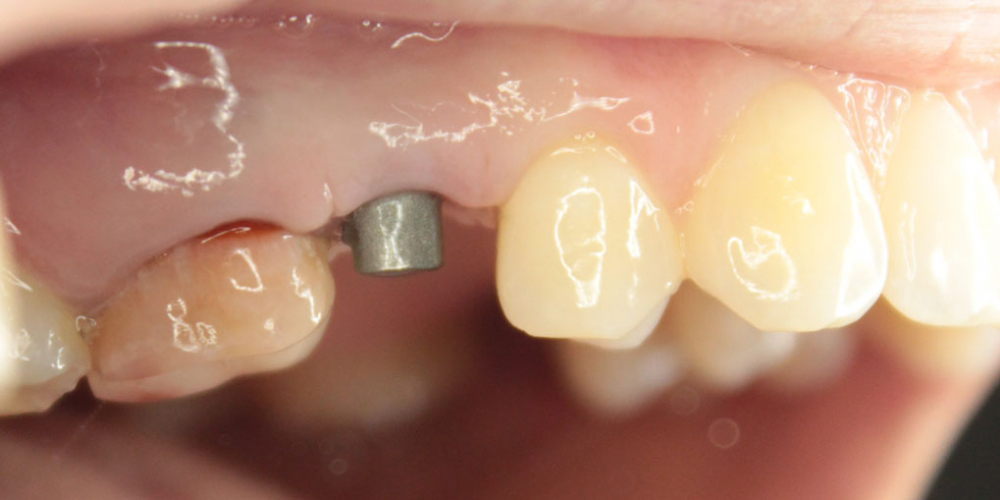  Восстановление зуба имплантация Osstem + протезирование м/к коронкой