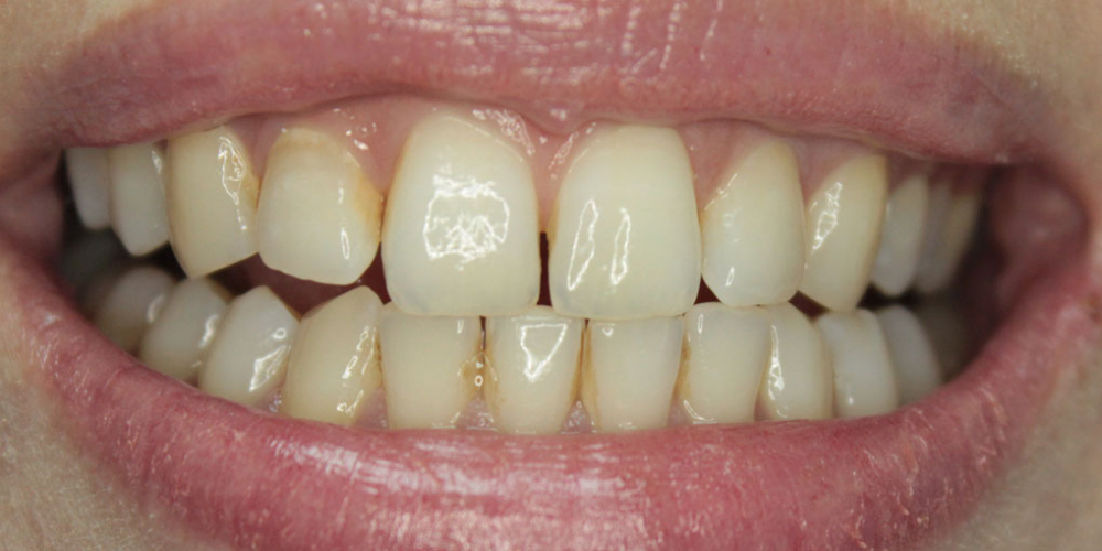  Результат отбеливания зубов ZOOM-4