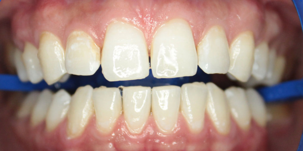  Результат отбеливания зубов ZOOM-4