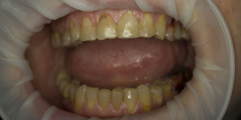 Восстановление двух зубов цельнокерамическими коронками Е-мах фото до лечения