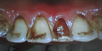 Профессиональная гигиена полости рта фото до лечения