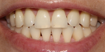 Результат отбеливания зубов системой Zoom-3 фото до лечения
