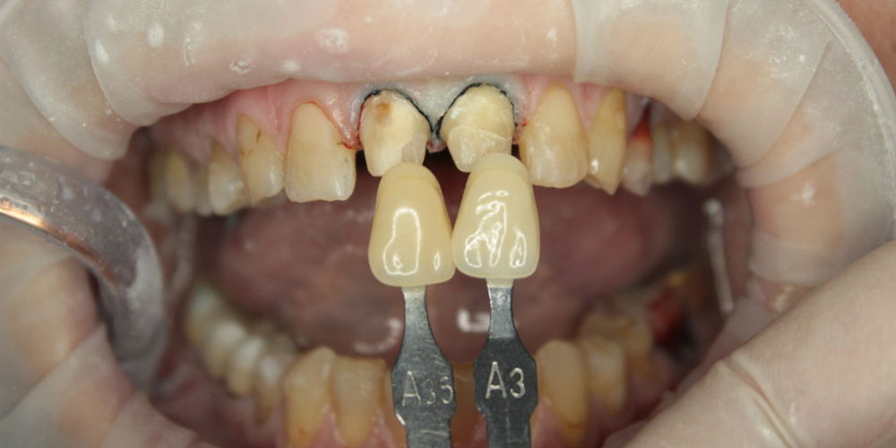 Восстановление двух зубов цельнокерамическими коронками Е-мах