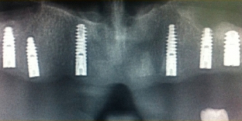 Установка 6 имплантов на верхнюю челюсть фото до лечения